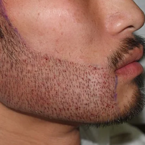 Beard hair transplant in delhi
