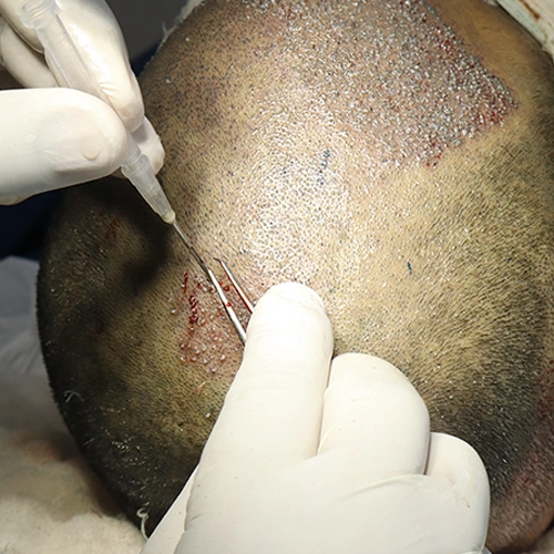 FUE hair transplant in delhi