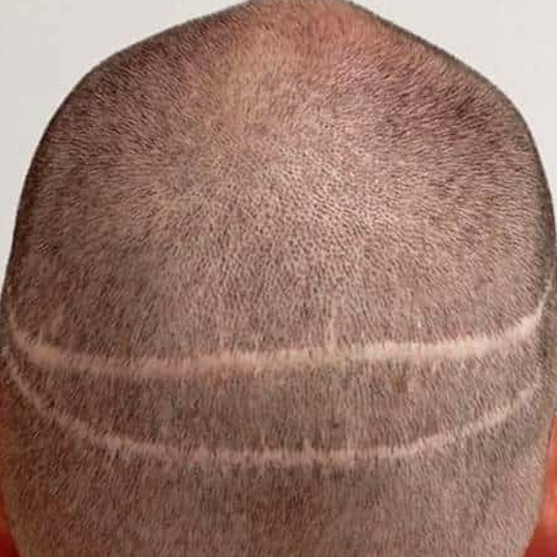 FUT hair transplant in delhi