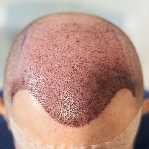 Male hair transplant in delhi