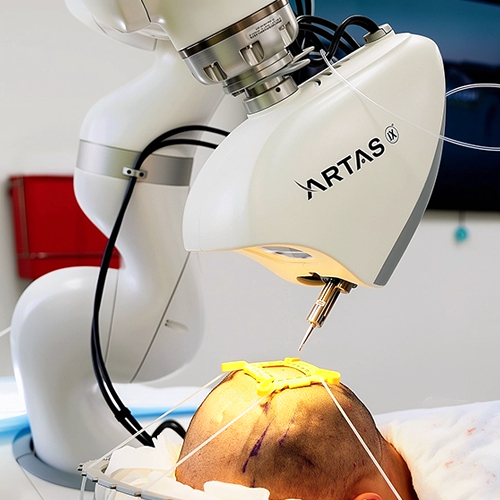 Robotic hair transplant in delhi
