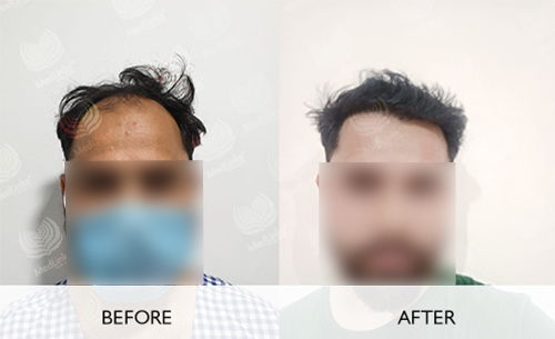 Hair Transplant Before And After | Medlinks | Result Hair Transplant Before And After | Medlinks | Result