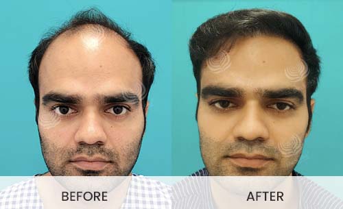 What to Expect After your Hair Transplant  La Densitae
