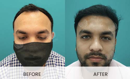 Hair Transplant Before And After | Medlinks | Result Hair Transplant Before And After | Medlinks | Result
