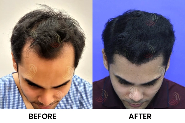 Hair Transplant Before And After | Medlinks | Result