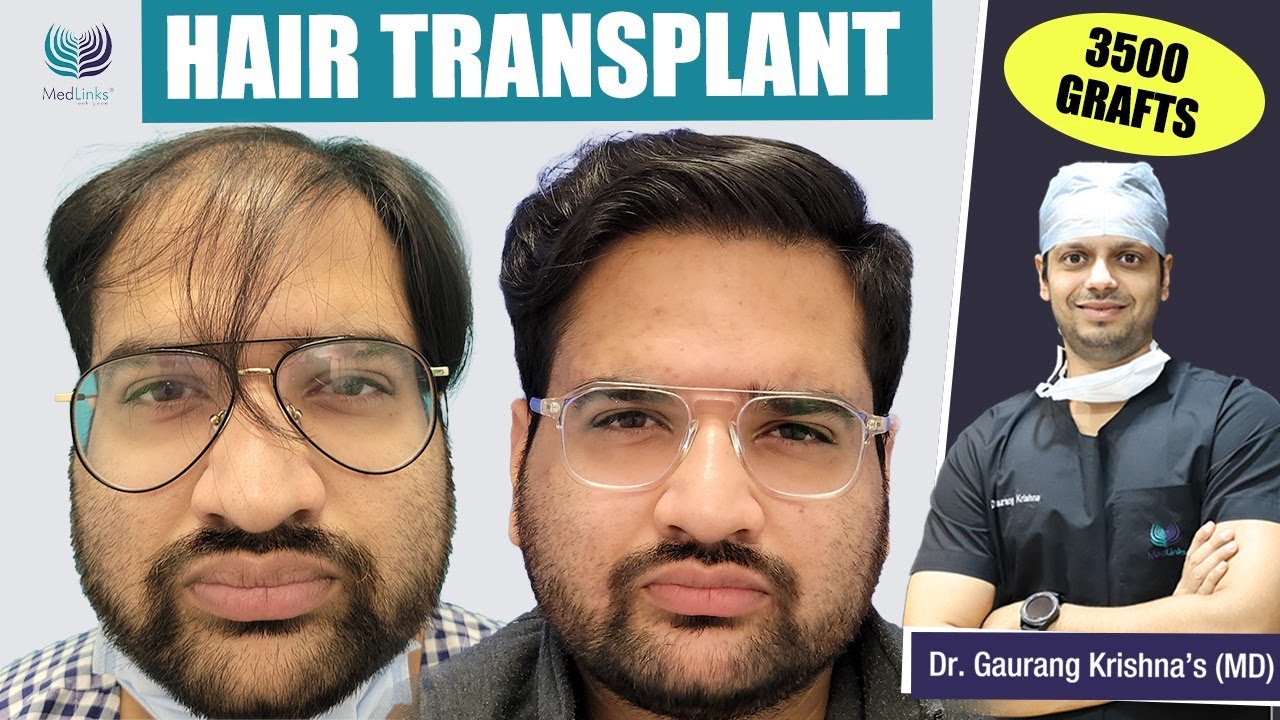 Hair transplant cost in Hyderabad | Medlinks