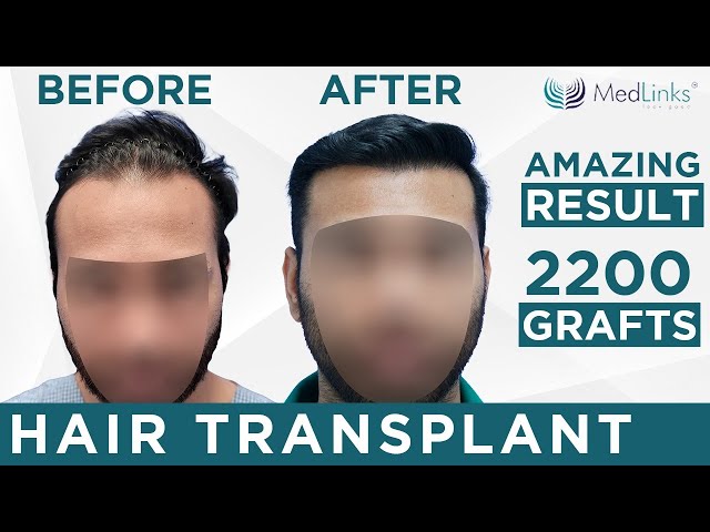Hair Transplant Price in Delhi | Cost of Hair Transplant in Delhi Hair Transplant Price in Delhi | Cost of Hair Transplant in Delhi