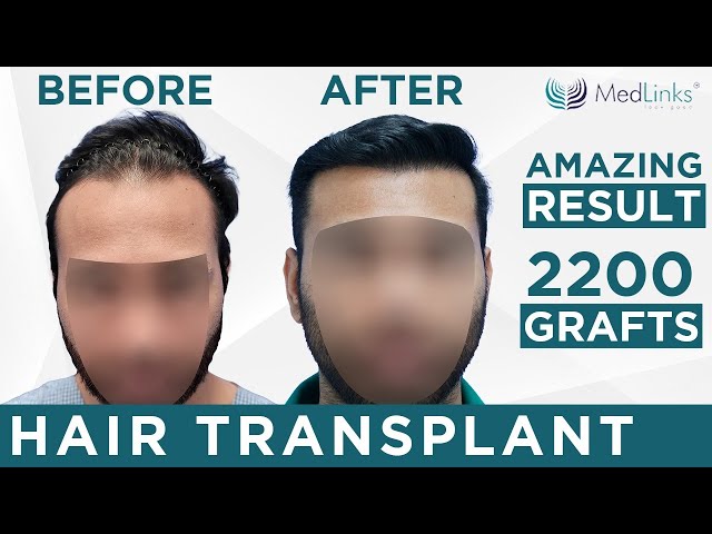 Best Hair Transplant Doctor in Delhi  Hair Treatment Clinic DelhiNCR