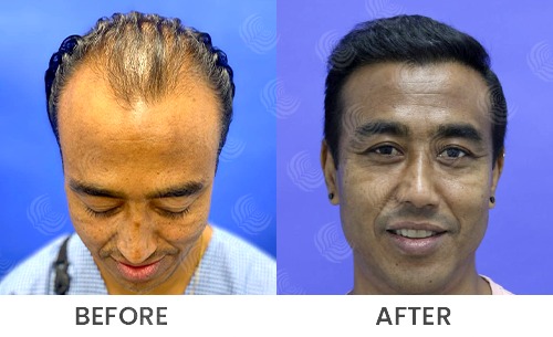 Hair Transplant Before And After | Medlinks | Result Hair Transplant Before And After | Medlinks | Result