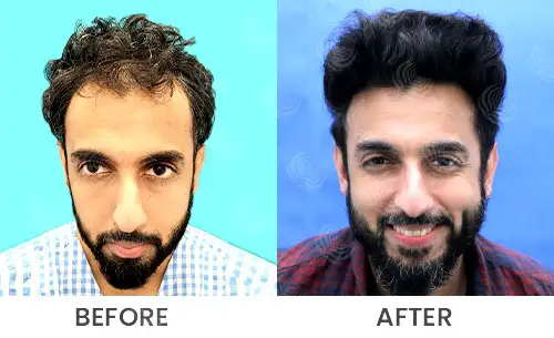 hair-transplant-india