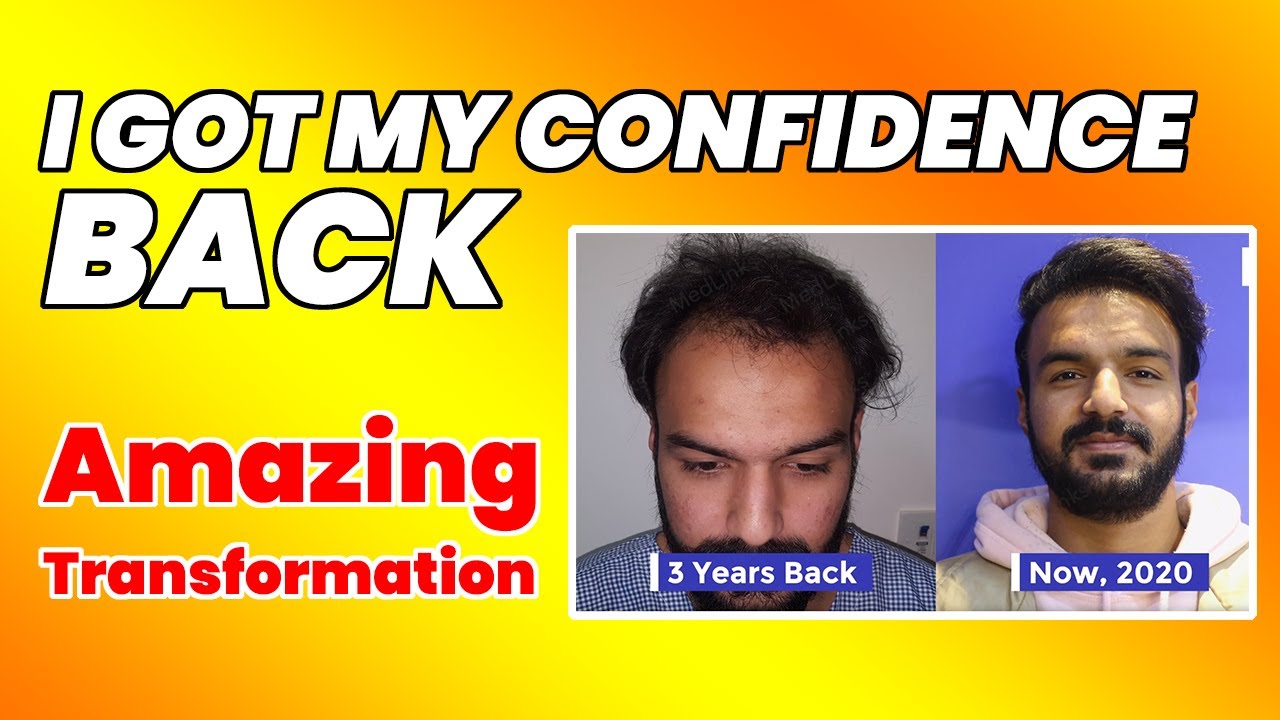Shockloss after hair transplant surgery in delhi