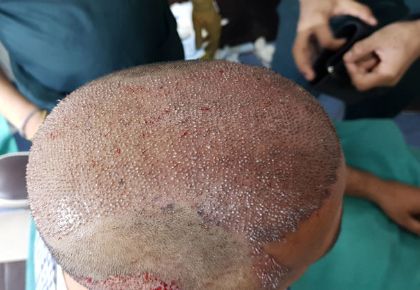 Precautions After Fue Hair Transplant Surgery