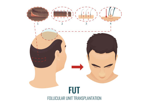 What is the Sapphire FUE hair transplant technique  Cyber Hairsure