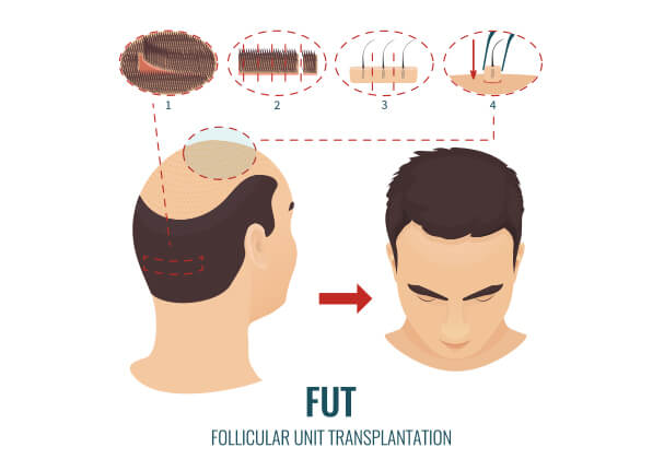 FUT hair transplantation in Delhi