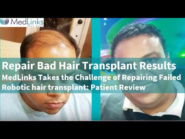 Repair Hair Transplant In Delhi | Fixing Bad Hair Transplant | Medlinks