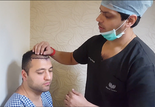 Shockloss after hair transplant surgery in delhi