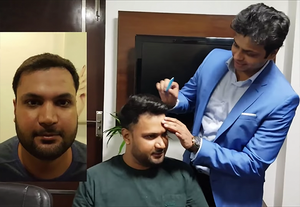 Shockloss after hair transplant surgery in delhi