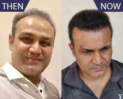 5 Best Hair transplant surgeons in Hyderabad, TS - 5BestINcity.com
