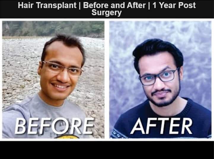Best hair transplant in india