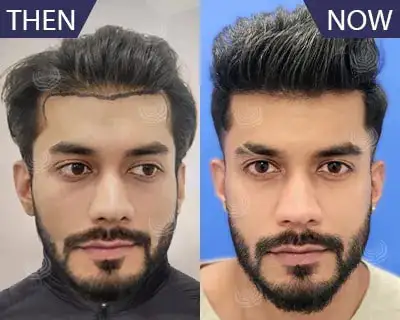 What is the Cost or Price of Hair Transplant in Ahmedabad ?
