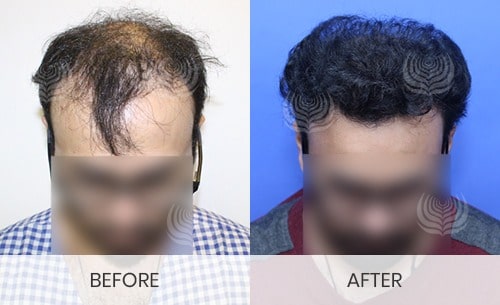 hair-transplant-in-delhi