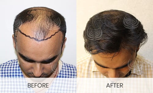 best-hair-transplant-in-delhi