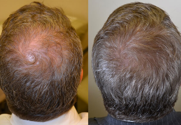 hair transplant evolution