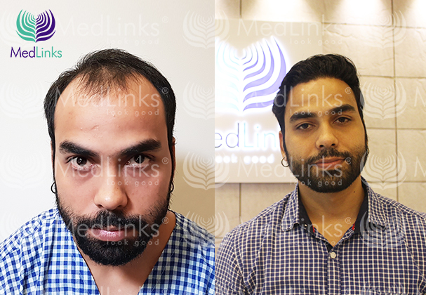 Perfect - i vs FUE hair transplant