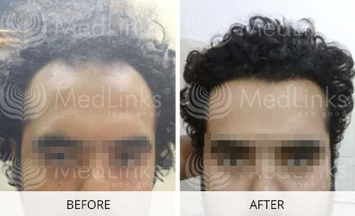 Hair Transplant Before And After | Medlinks | Result