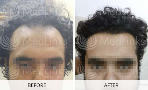 Hair Transplant Before And After | Medlinks | Result Hair Transplant Before And After | Medlinks | Result