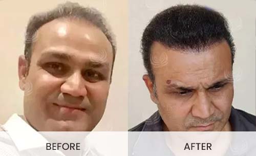 Celebrity Hair Transplant | Medlinks Celebrity Hair Transplant | Medlinks
