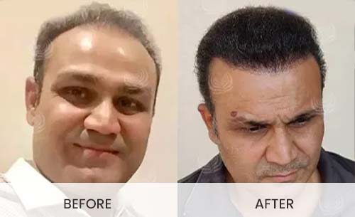 Celebrities Who Underwent A Hair Transplant Surgery