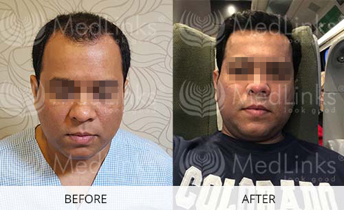 Hair Transplant Before And After | Medlinks | Result Hair Transplant Before And After | Medlinks | Result