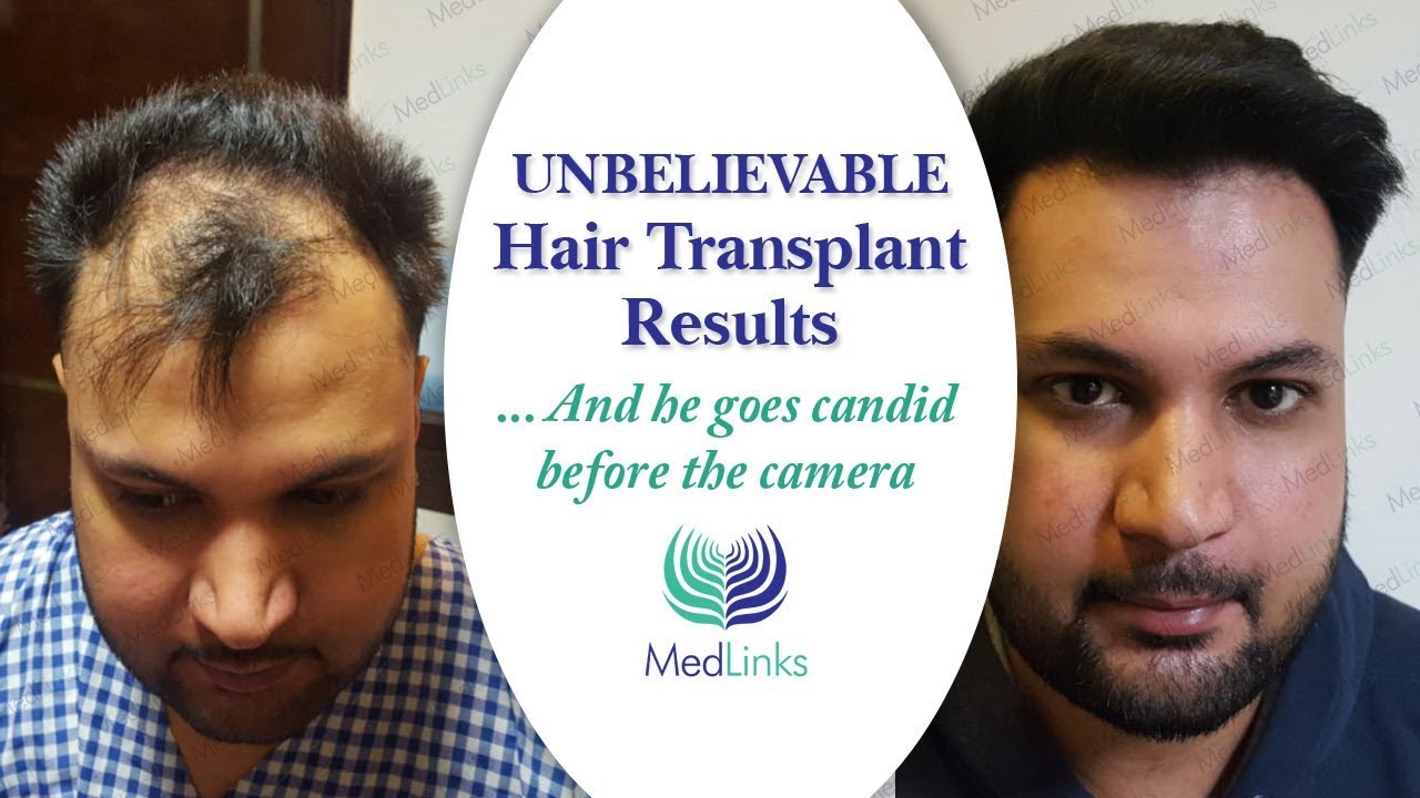Hair transplant cost in Hyderabad | Medlinks