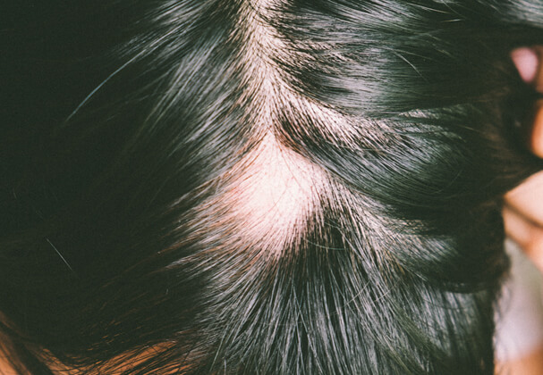 Scarring Alopecia Treatment in Delhi at MedLinks