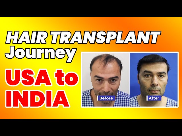 MedLinks hair transplant Patient from India