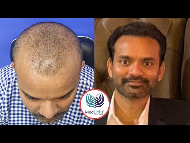 MedLinks hair transplant Patient from India