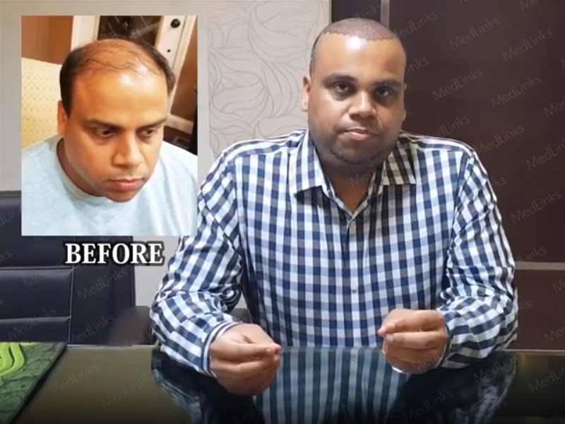 MedLinks hair transplant Patient from USA