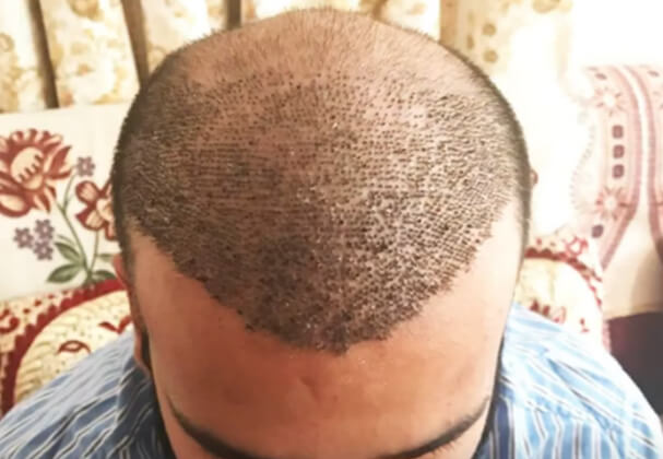 Traditional vs Modern Technique In Hair Transplant  Artius Hair Transplant