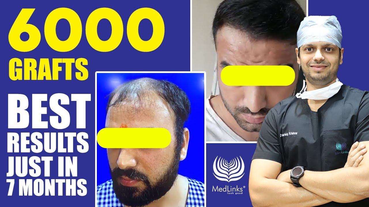Hair Transplant in Hyderabad, India • Check Prices & Reviews