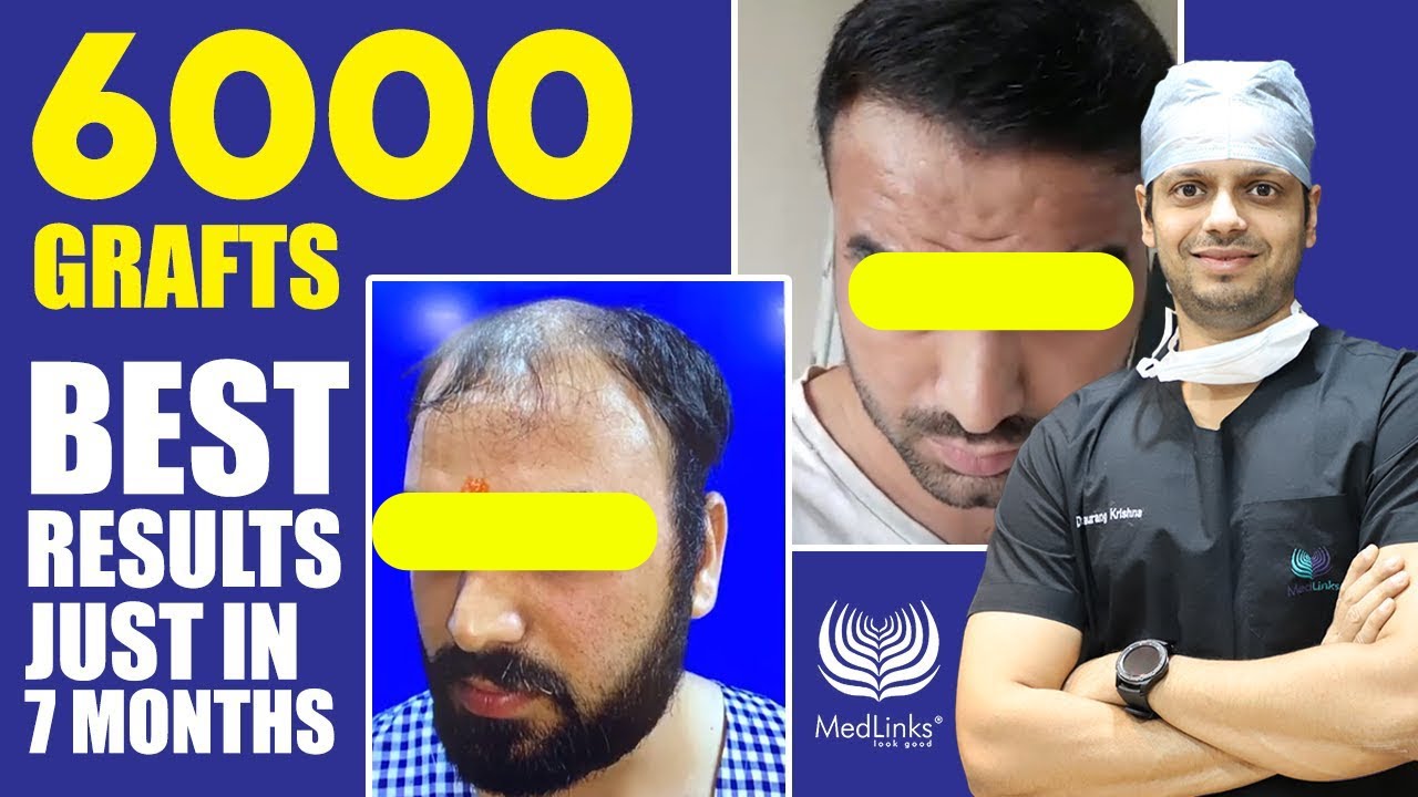 Hair Transplant in Delhi  Best Hair Transplant Clinic in Delhi  India