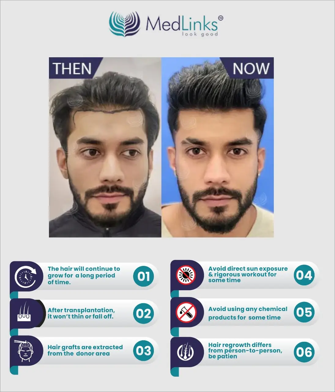 how-to-sleep-after-hair-transplant