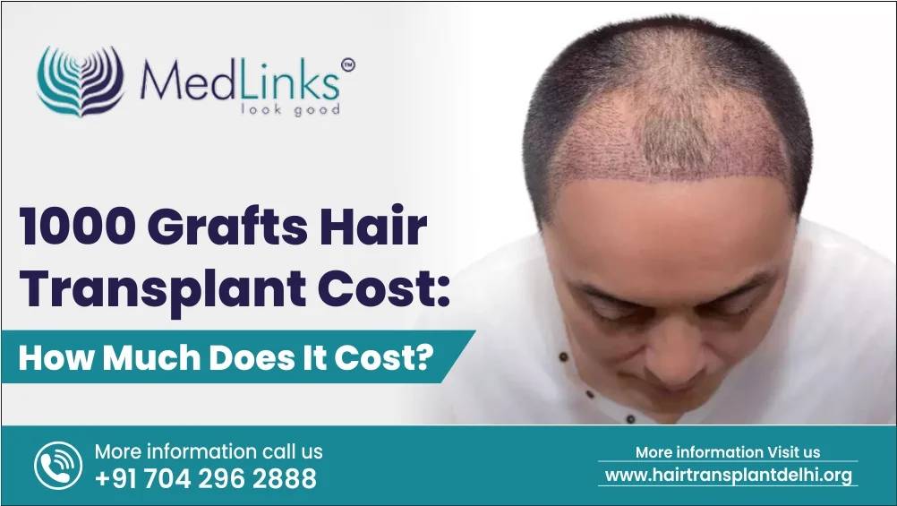 1000 Grafts Hair Transplant Cost 2024: How Much Does It Cost?