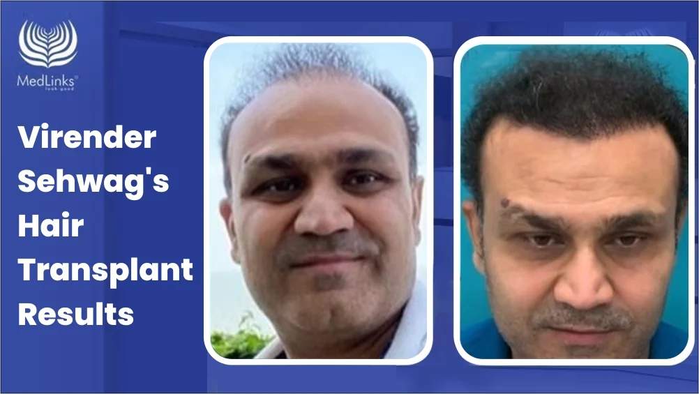 Virender Sehwag's Hair Transplant Results