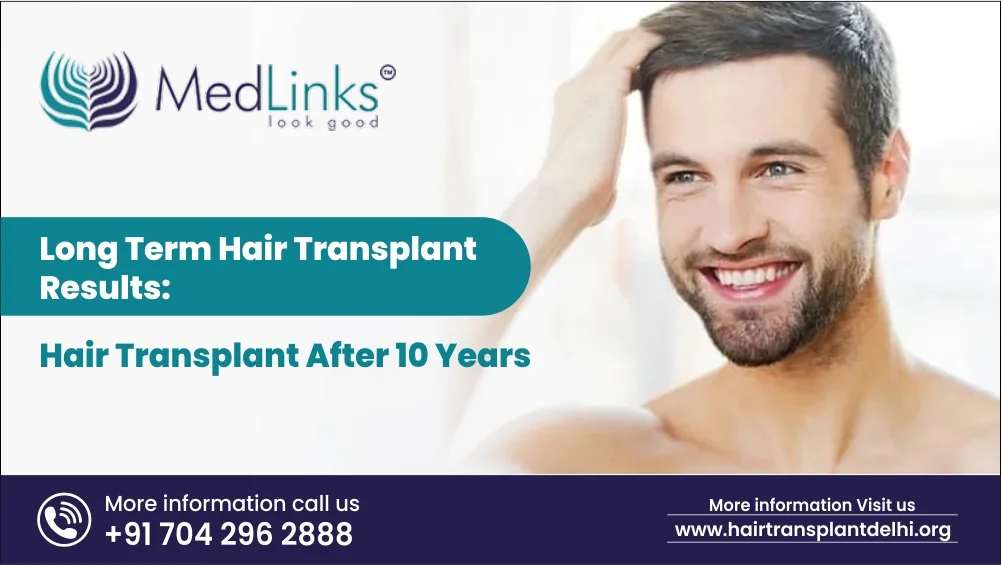 Long Term Hair Transplant Results: Hair Transplant After 10 Years