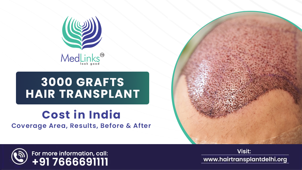 3000 Grafts Hair Transplant Cost in India – Coverage Area, Results, Before & After.