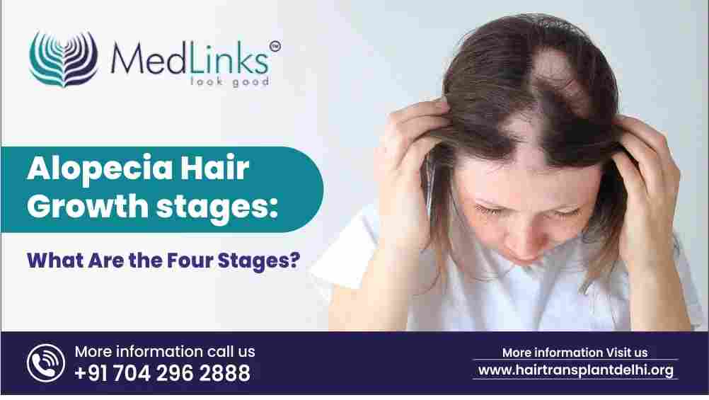 Alopecia Hair Growth Stages: What Are the Four Stages?