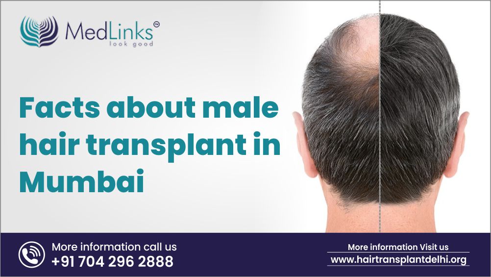 Facts about Male Hair Transplant in Mumbai