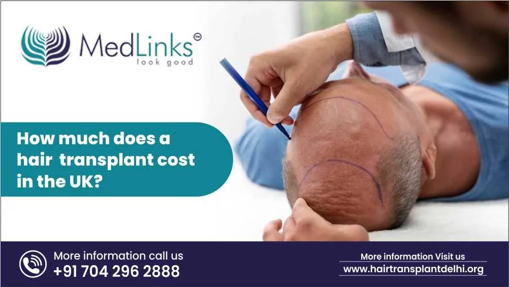 How Much Does a Hair Transplant Cost in the UK?