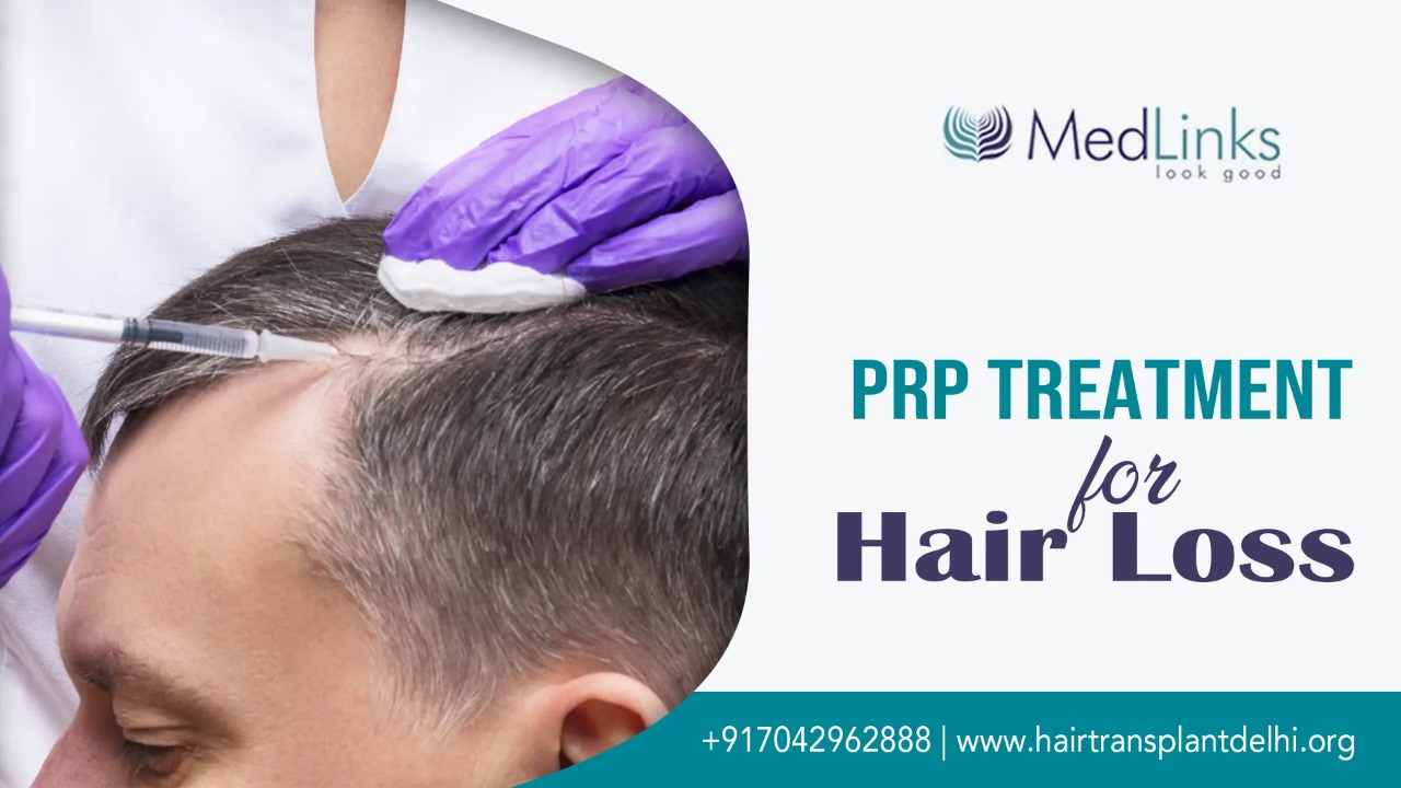 PRP Treatment for Hair Loss and How Long Does It Last?